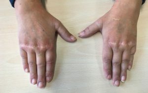 Manos extendidas Lupus--Eritematoso-cirugía-de-la-mano-y-traumatologia