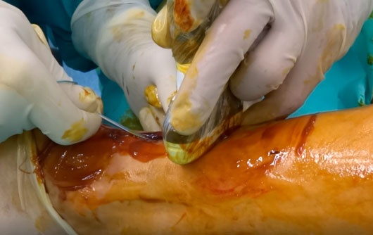 Sutura-con-cirugia-percutanea-del-tendon-de-aquiles