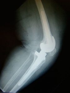 Por qué fallan las prótesis de rodilla. El uso de cemento con 1-2 antibióticos permitirá prevenir nuevas complicaciones, como en las prótesis primarias de rodilla.