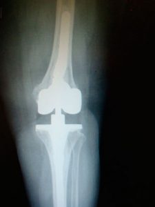 Por qué fallan las prótesis de rodilla. El uso de cemento con 1-2 antibióticos permitirá prevenir nuevas complicaciones, como en las prótesis primarias de rodilla.