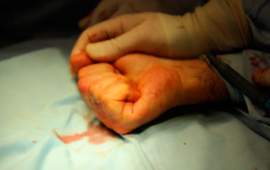 Metodo-Walant-en-cirugía-de-la-mano- Imagen intraoperatoria de flexión activa realizada por paciente consciente