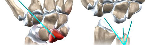 Enfermedad de Kienbock 13