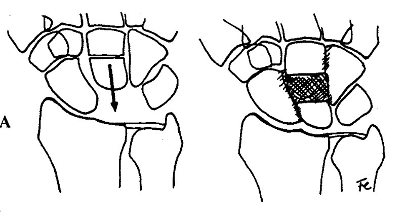 Enfermedad de Kienböck