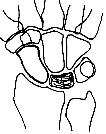 Enfermedad-de-Kienböck-8