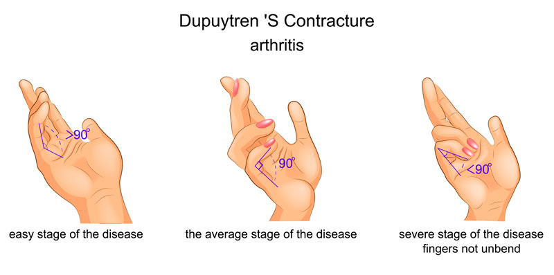 Grados de contractura en la Enfermedad de Dupuytren
