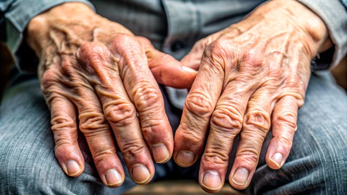 manos ancianas, manos en la 3ª edad, enfermedades y patologías de la mano degenerativa, en la tercera edad