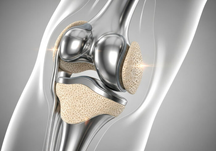 Descubre cuándo es necesaria una prótesis de rodilla, cómo es la operación, cuánto dura la recuperación, riesgos, tipos de implante y resultados esperables.