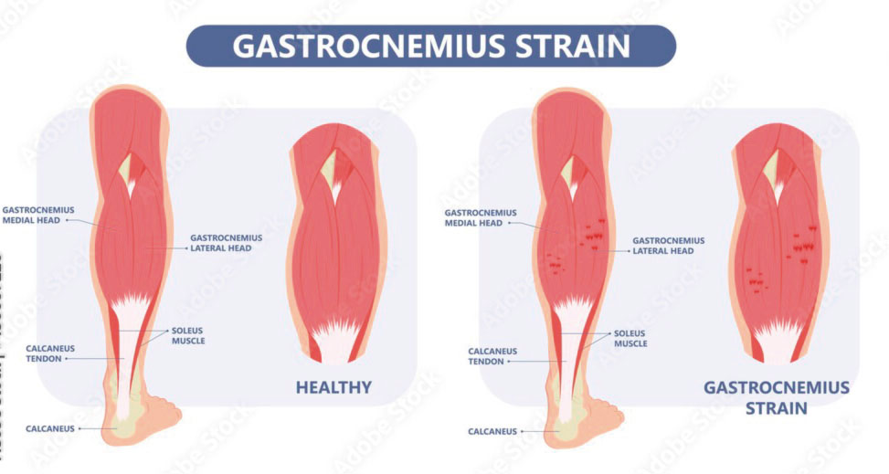 Acortamiento de gemelos y dolor en el pie