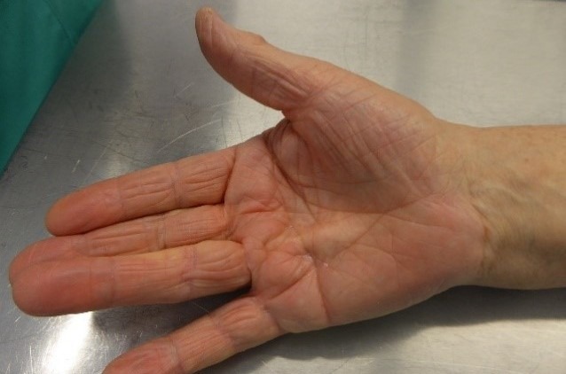 Cirugia Ecoguiada Avanfi Enfermdedad Dupuytren 03 638x422 1