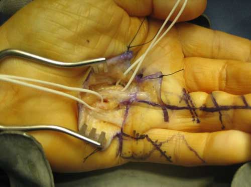 Cirugia Ecoguiada Dupuytren