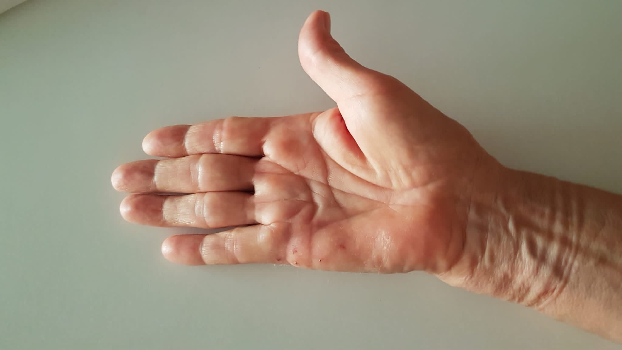 Cirugía ecoguiada del Dupuytren: qué es, cuándo se indica y qué ventajas ofrece