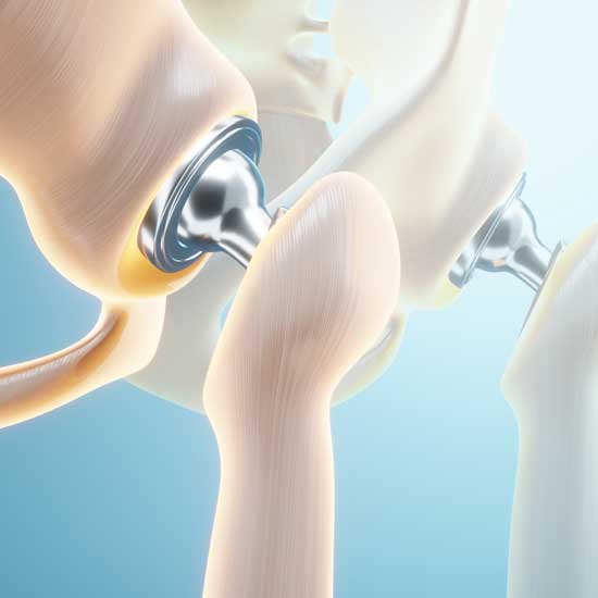 ilustración médica de una prótesis total de cadera implantada