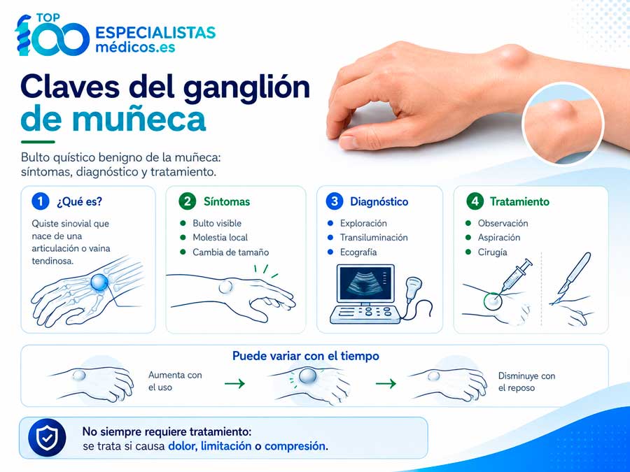 Claves del ganglión de la muñeca: causas, síntomas, diagnóstico y cirugía