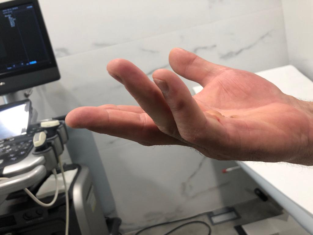 Cirugía ecoguiada Dupuytren: resultado intraoperatorio