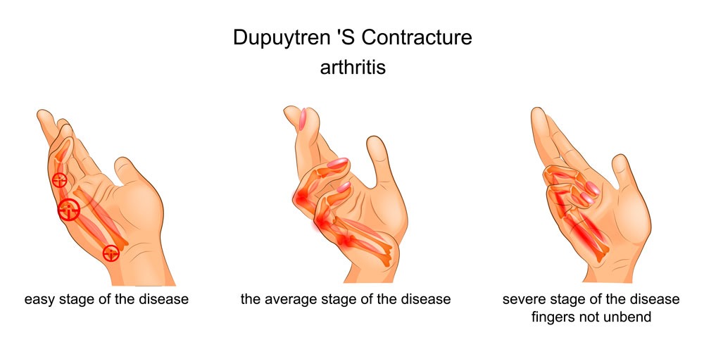 Postoperatorio del Dupuytren: recuperación funcional de la mano