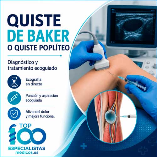 Aspiracion ecoguiada de un quiste de Baker mediante control ecografico