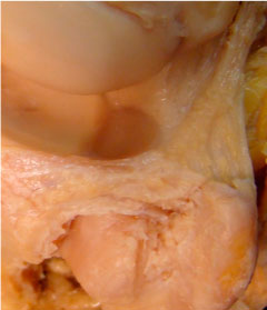 Complejo del fibrocartilago triangular