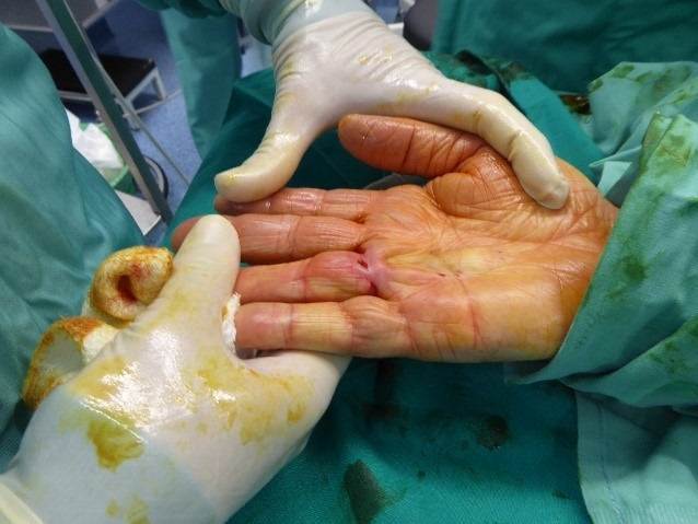 Cirugía ecoguiada del Dupuytren: imagen intraoperatoria