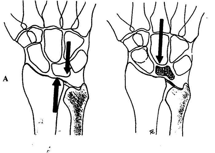Zonas del dorso de la mano clasificación de Kleinert y Verdan