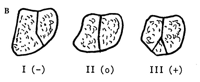 Enfermedad de Kienböck - imagen diagnóstica