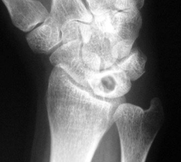 Ganglión intraóseo del semilunar