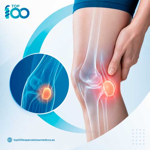 Acumulacion de liquido sinovial en un quiste de Baker detras de la rodilla