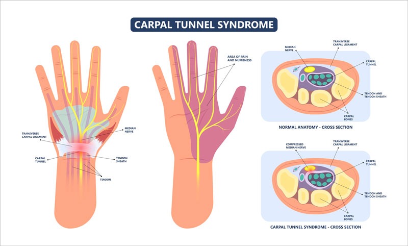 Sindrome del tunel carpiano anatomia