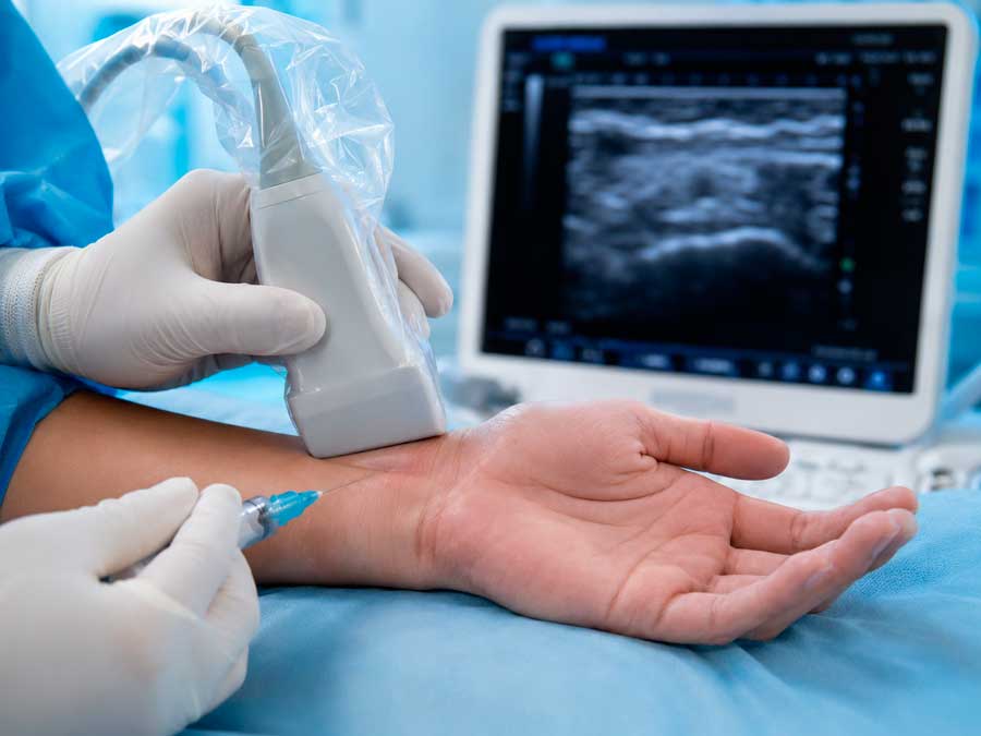 infiltracion ecoguiada sindrome tunel carpiano