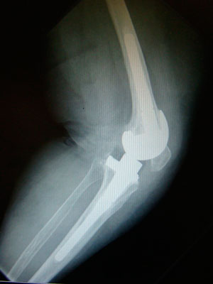Revisión de prótesis de rodilla imagen 1