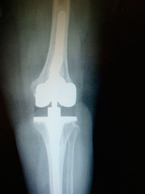 Revisión de prótesis de rodilla imagen 2